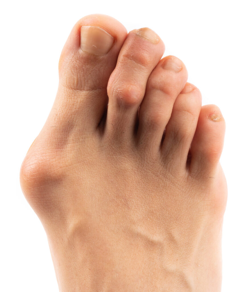 Bunion